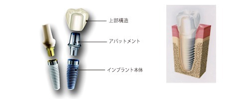 歯科矯正用アンカースクリュー（デュアル・トップオートスクリュー等）の構造