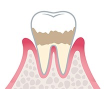 歯周病 進行状況 軽度歯周病