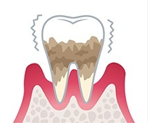 歯周病 進行状況 重度歯周病